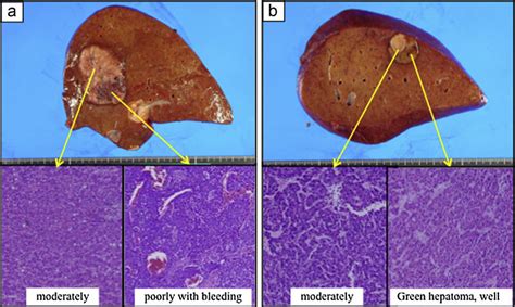 The Macroscopic And Pathological Findings Of Two Tumors Both Tumors