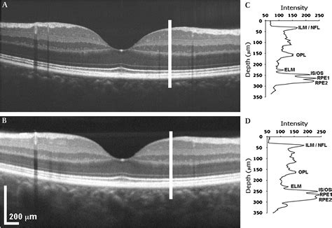 Retinal Imaging Using Commercial Broadband Optical Coherence Tomography British Journal Of