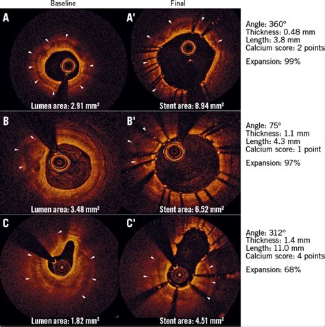 A New Optical Coherence Tomography Based Calcium Scoring System To Predict Stent Underexpansion