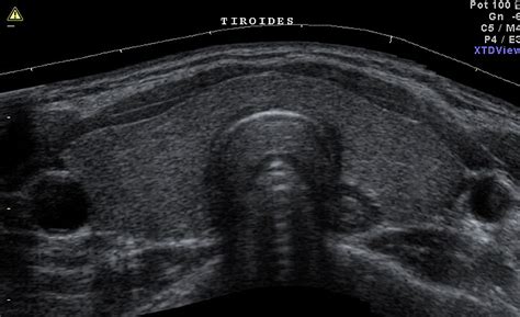 Ecografia Tiroidea Centro Médico Semecor