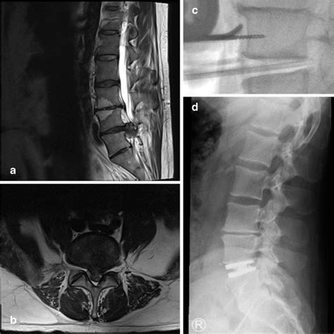 Lumbar Arthroplasty For Treatment Of Primary Or Recurrent Lumbar Disc