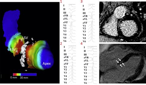 Impact Of Intramural Scar On Mapping And Ablation Of Premature