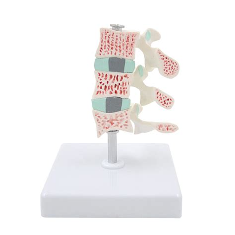 Buy Human Spine Lumbar Vertebrae Model 3 Stage Medicals Lumbar