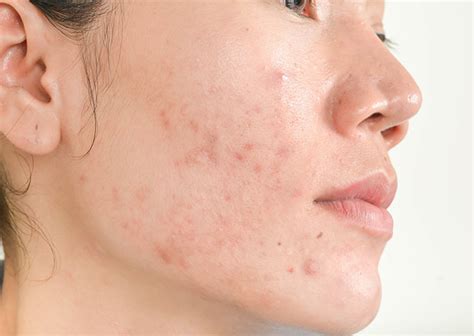 Acne | Lorna Vanderhaeghe