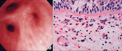 Bronchoscopic appearance and histologic findings of bronchial mucosal ...