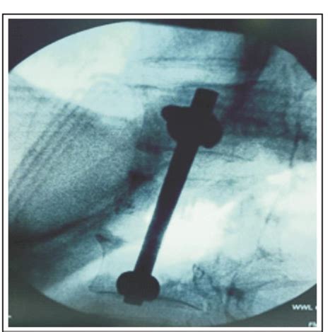 Figure 1 From Anterior Lateral Approach For Anterior Decompression