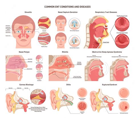 Premium Vector Common Ent Diseases Set Nose Throat And Ears Bacterial