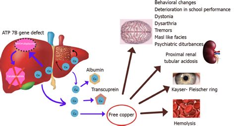 Pathophysiology Of Wilsons Disease Due To Mutation In Atp 7b Gene P