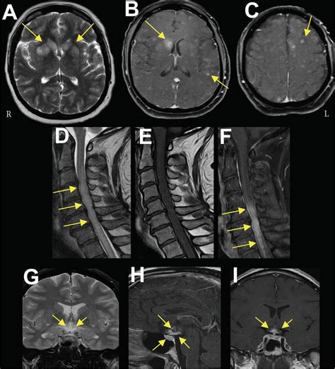 Mri In Neurosarcoidosis Axial T Image A And Axial Post Contrast