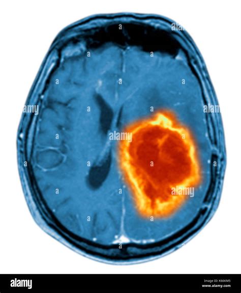 Irm Anormal Du Cerveau Banque De Photographies Et Dimages Haute