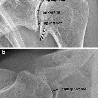 True Anteroposterior Ap X Ray A And Axillary View B Of A Left