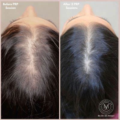 Hair Loss Treatment Success Story MONARCH MD HAIR LAB MD