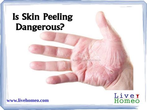 Is skin peeling dangerous | PPT | Free Download