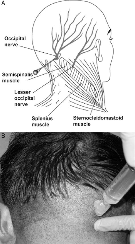 Occipital Nerves Block A This Diagram Illustrates Greater Occipital Download Scientific