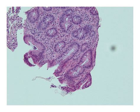 Ascending Mucosal Biopsy Demonstrating Ulceration And Active