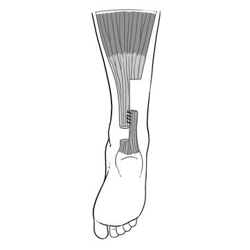 Achilles Lengthening Journal Of The Pediatric Orthopaedic Society Of