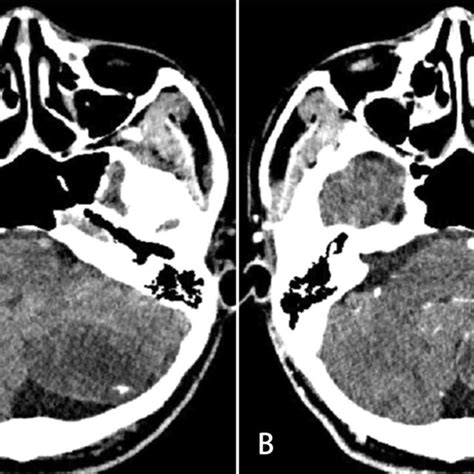 MRI Findings Of A 27 Year Old Man With Intraparenchymal Schwannoma A