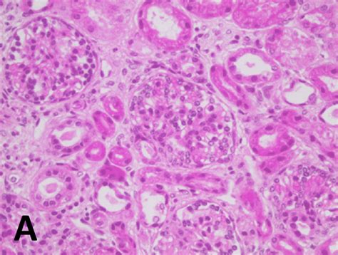 A Renal Biopsy Histology Showing Mesangial Hypercellularity And Focal