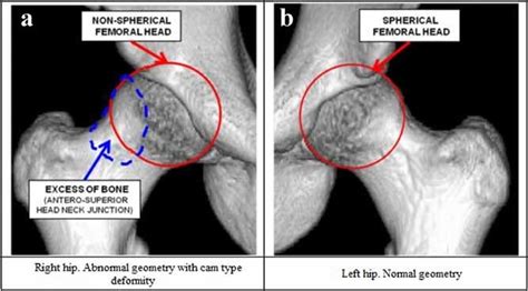 Changes In The Stress In The Femoral Head Neck Junction After