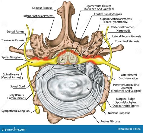 Board Stenosis Lumbar Disk Herniation Stock Photo Image Of Crossing