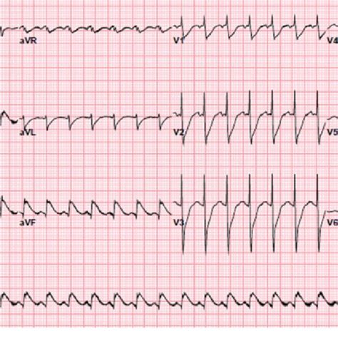 Ekg Showing St Elevations In Lead Ii Iii Avf And V6 Download Scientific Diagram