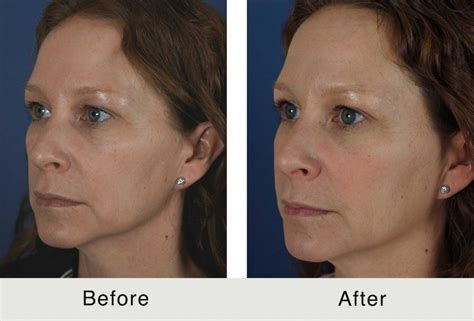 Temple Augmentation Carolina Facial Plastics