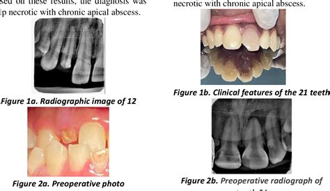 Figure 1 From Bone Regeneration On Chronic Apical Abscess After Root Canal Treatment Semantic