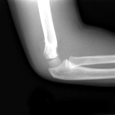 Supracondylar Humerus Fracture