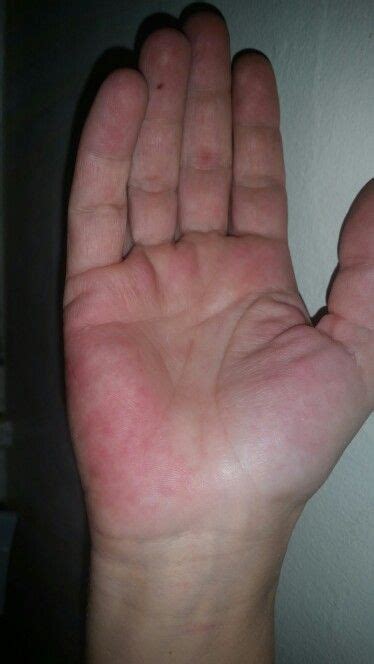 Lupus rash on hand | Lupus rash, Rash on hands, Lupus