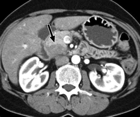 Pancreatic Surgery For The Radiologist 2011 An Illustrated Review Of