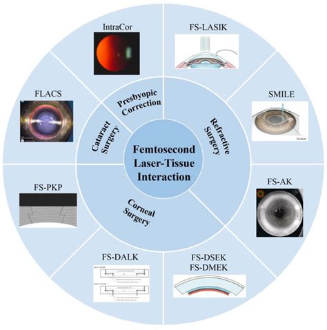 Micromachines Free Full Text Femtosecond Laser Assisted Ophthalmic Surgery From Laser