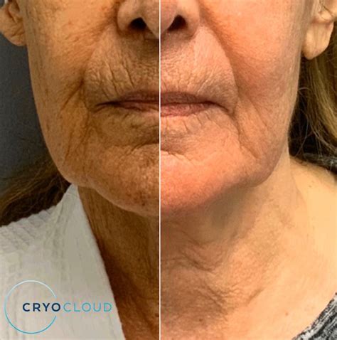 Cryo T Shock Facial Cryo Cloud Llc