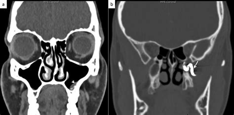 Postoperative Ct Scan In Coronal Reconstruction Showing The Total