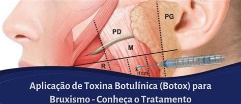 Toxina Botulínica Botox para Bruxismo Masseter Dermatologista