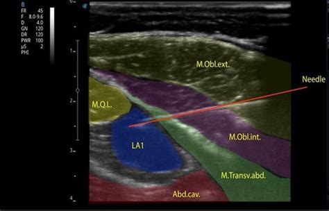 B15 Ultrasound Guided Transversalis Fascia Plane Blockfor Postoperative Pain Control In