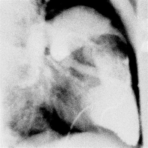 Right Ventricular Angiogram In Right Lateral View Showing A Large