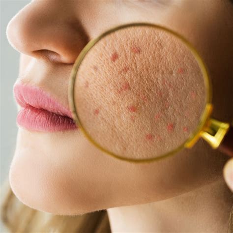 Navigating Adult Acne Exploring The Different Types And Finding Your