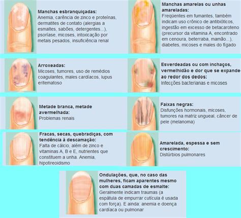 Manchas Nas Unhas Saiba O Que Significa