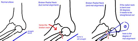 Kids - Radial Neck Fracture — Bone Talks