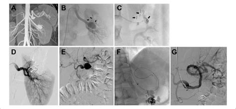 A A 32 Year Old Asymptomatic Woman Had Renal And Splenic Aneurysms Download Scientific