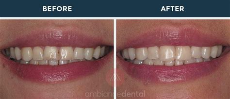 The Difference Between Veneers And Dental Bonding • Ambiance Dental