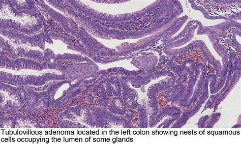 Pathology Outlines Tubulovillous Villous Adenoma