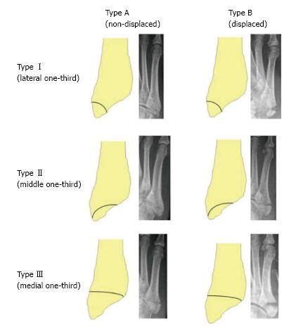 Tuberosity Of 5th Metatarsal Pain