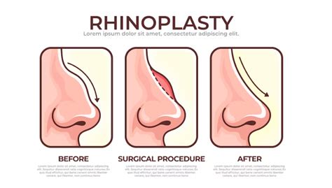 How To Get A Nose Job For The Roman Nose Medical Tourist And Cosmetic Surgery