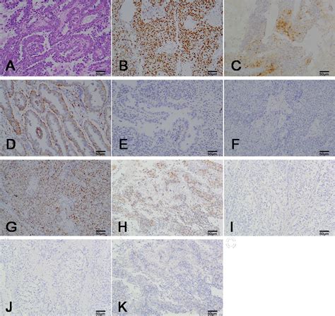 Frontiers Clear Cell Carcinoma Of The Endometrium Evaluation Of