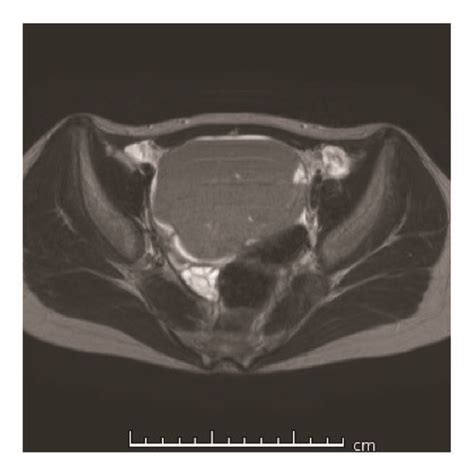 Pelvic Magnetic Resonance Imaging T Weighted Image Before The First