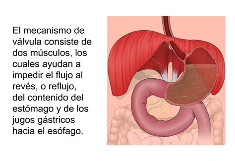 PatEdu Enfermedad de reflujo gastroesofágico