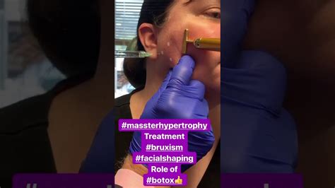 Botox For Treatment Of Tooth Grinding YouTube