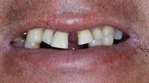 Procedimientos Combinados Caso Cosm Tica Dental Burga