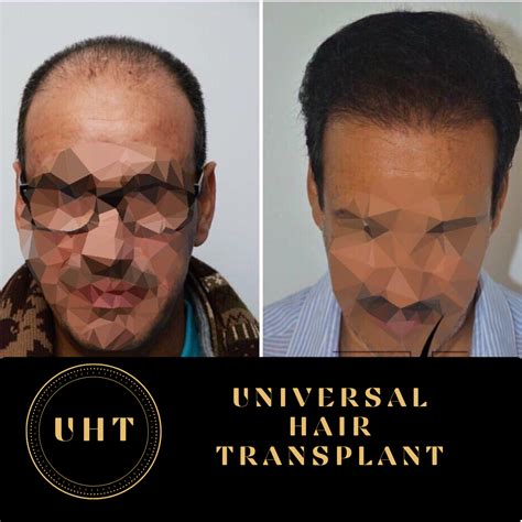 Universal Fue Hair Transplant Turkey Istanbul